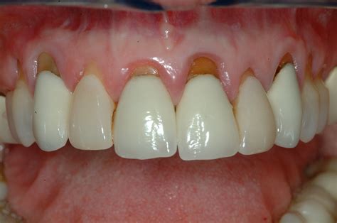 Gum Tissue Grafting in Las Vegas & Henderson.